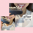 before after☆