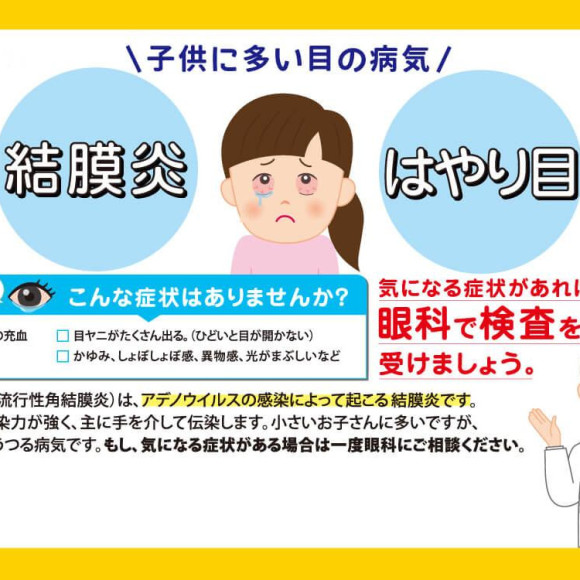 アデノウイルス（はやり目）について